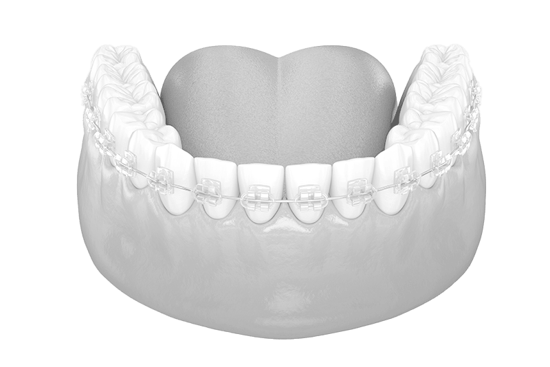 Translucent (Ceramic) Braces, Types of Braces